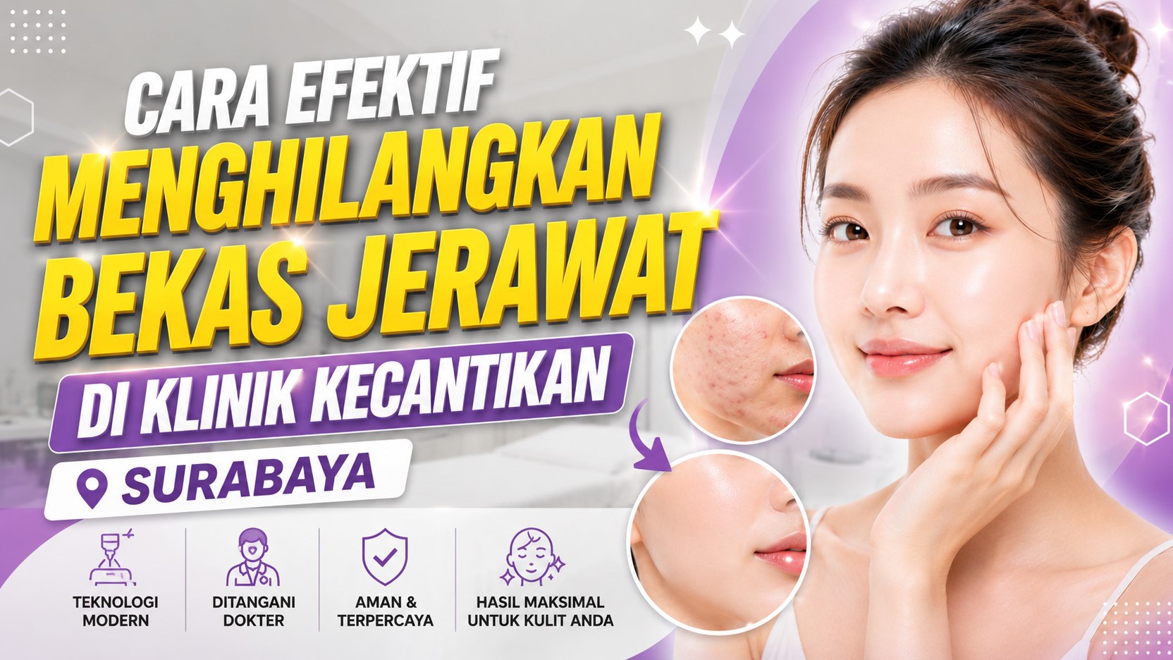 Menghilangkan Bekas Jerawat di Klinik Kecantikan